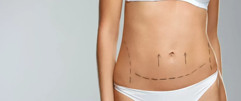 Risks and Rewards of Liposuction – A Guide for Patients