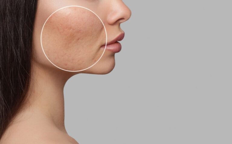Fractional Co2 Laser
