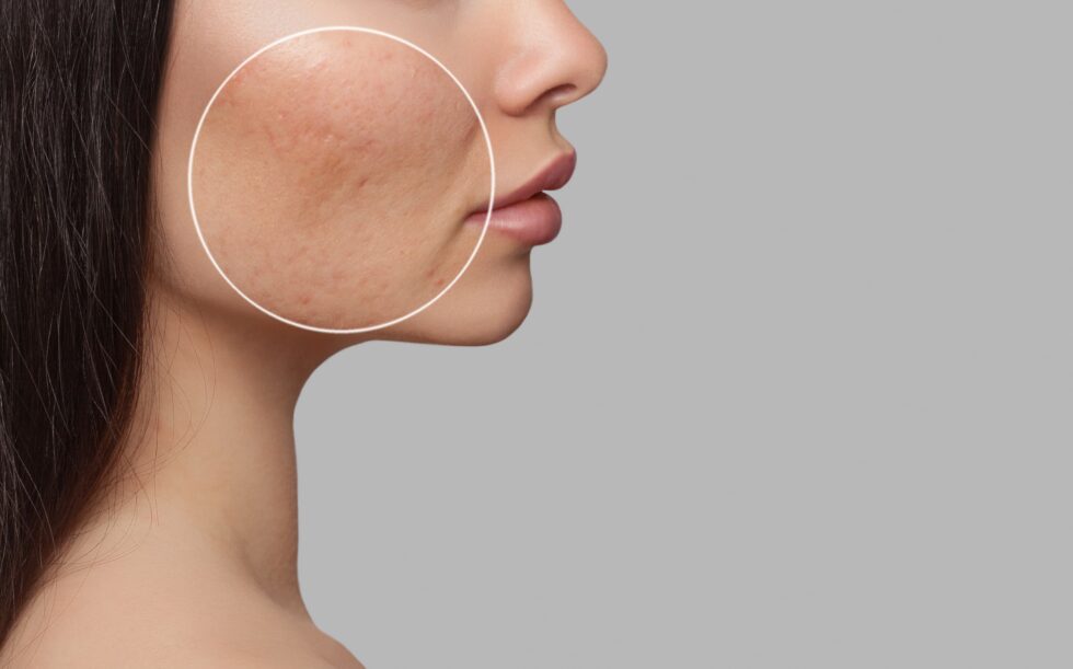 Fractional Co2 Laser