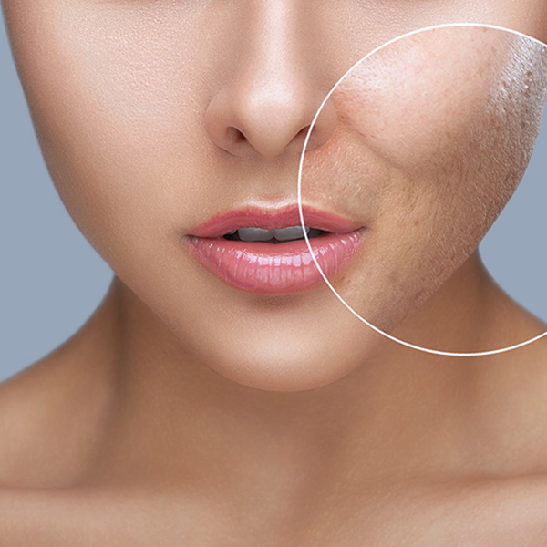 Laser Skin Rejuvenation