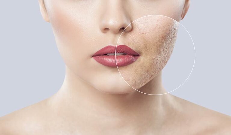 Laser Skin Treatment