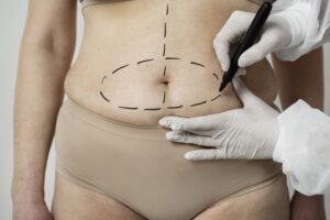 Abdominal area with circular surgical markings drawn by a marker, a gloved hand nearby for guidance.