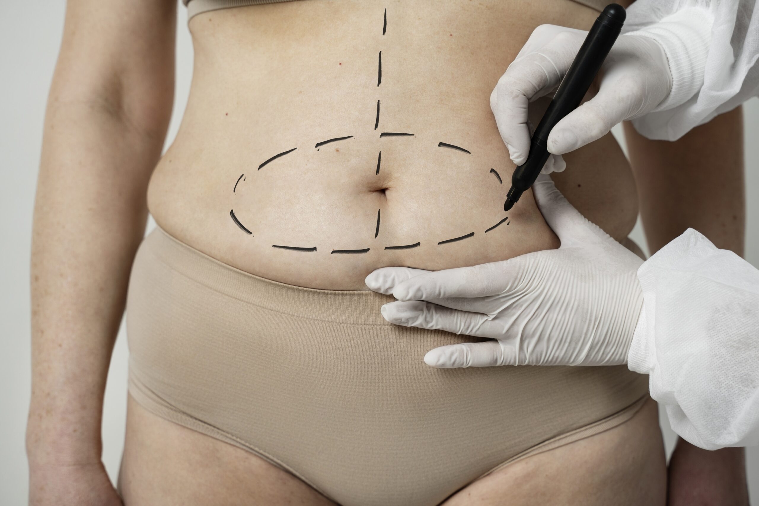 Read more about the article Should I Choose VASER Liposuction Over Traditional Liposuction? Is It About Fat Removal or Body Contouring?